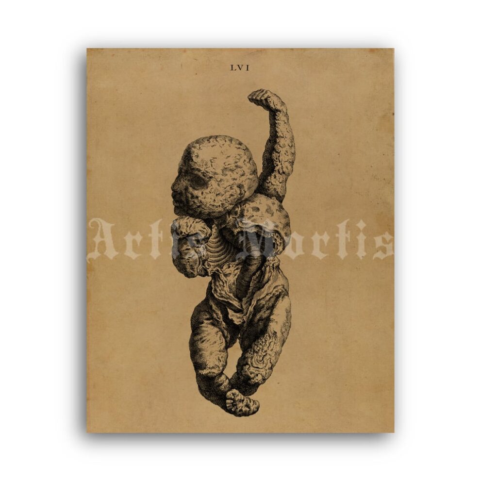Printable Anomaly fetus skeleton, stone baby – anatomy, pathology print - vintage print poster