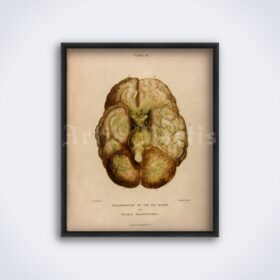 Printable Human brain pathology, morbid anatomy, neurology illustration - vintage print poster