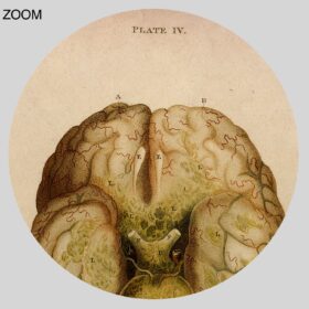 Printable Human brain pathology, morbid anatomy, neurology illustration - vintage print poster