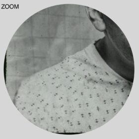 Printable Lobotomy victim medical photo, psychosurgery, psychiatry - vintage print poster