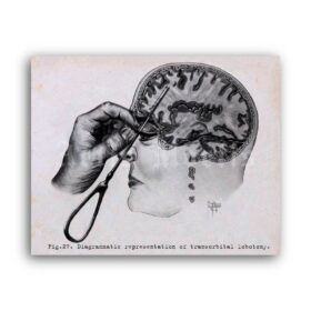 Printable Transorbital lobotomy neurology, psychosurgery print - vintage print poster